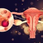 Yumurtalık kanserinde bu belirtilere dikkat! Kadınlarda en sık görülen 3’üncü kanser türü…