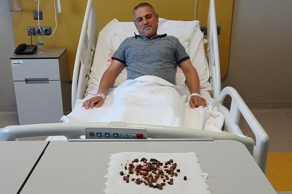 Doktorları şaşkına çeviren vaka: Adamın böbreğinden 100’e yakın taş çıktı: “Sağ böbreğin tamamı taşla doluydu”