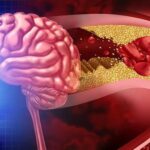 İnme Sonrası Yeniden Doğuş: ‘Milattan Önce ve Sonra Gibi’ Deneyimler!