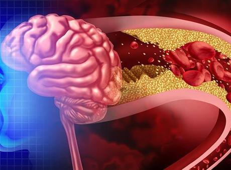 İnme Sonrası Yeniden Doğuş: ‘Milattan Önce ve Sonra Gibi’ Deneyimler!